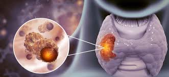 Dlaczego rośnie rak tarczycy?