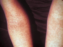 Choroba Denga: co to jest, objawy, faza krytyczna, leczenie i szczepionka w Polsce